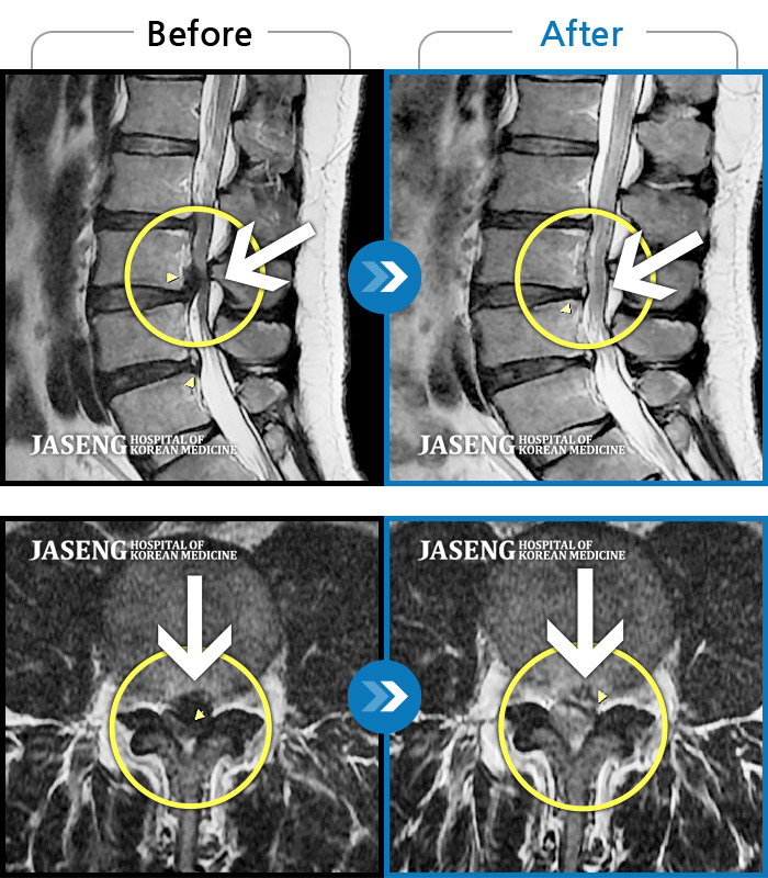 해운대자생한방병원 치료사례 MRI로 보는 치료결과-좌측 허리 골반과 다리에 뻐근함, 찌릿한 통증