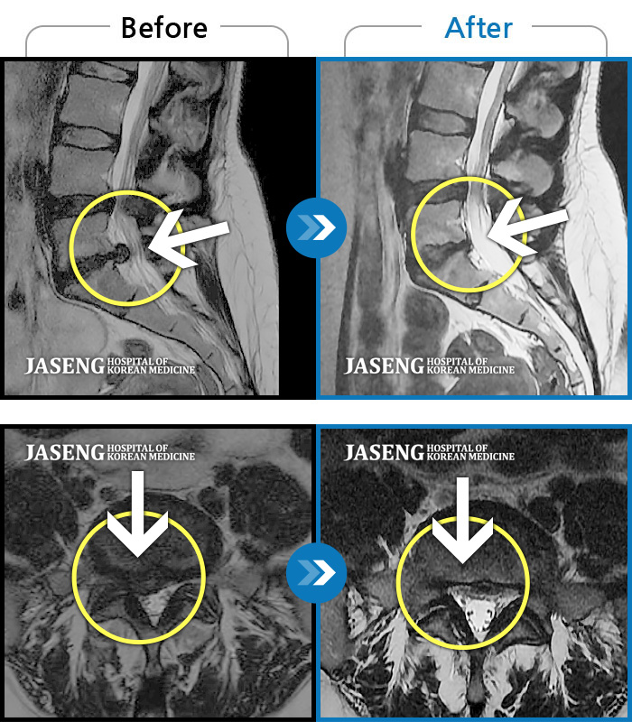 해운대자생한방병원 치료사례 MRI로 보는 치료결과-허리 골반이 뻐근하게 아프고 양측 다리가 당겼다.