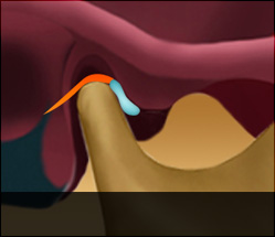 해운대자생한방병원 턱질환 턱관절장애-정상디스크 위치의 입을 다물고 있는 상태