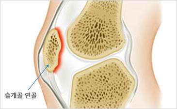 해운대자생한방병원 무릎질환 슬개골연골연화증-슬개골 연골이 위치해 있는 무릎 설명 이미지