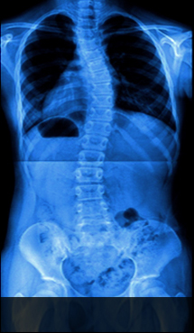 해운대자생한방병원 허리질환 척추측만증-척추측만증에 관련된 이미지 입니다.