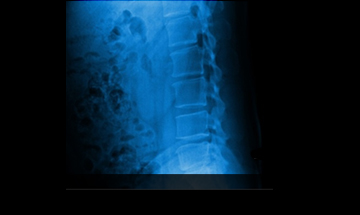 해운대자생한방병원 허리질환 척추후만증-척추후만증에 관련된 이미지 입니다.