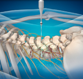 해운대자생한방병원 허리치료법 신경근회복술-신경근회복술의 특징 두번째 관련 사진 입니다.