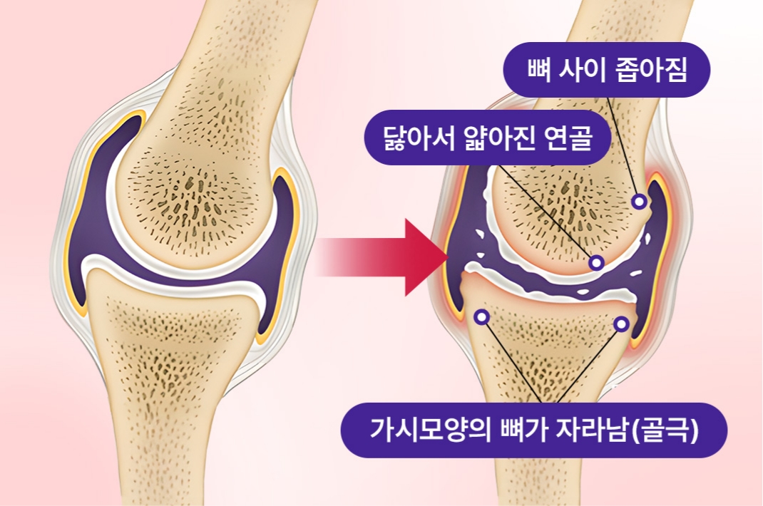 무릎 관절 연골이 닳고 뼈 사이가 좁아진 모습을 나타낸 일러스트